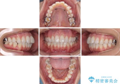 少しだけ飛び出た前歯を整えたい インビザラインによる矯正治療の治療中
