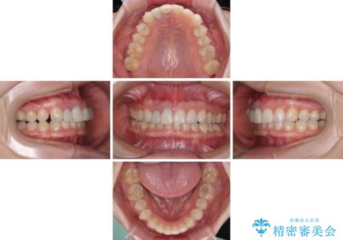 一度諦めた矯正にチャレンジしたい インビザラインとセラミック治療の治療中