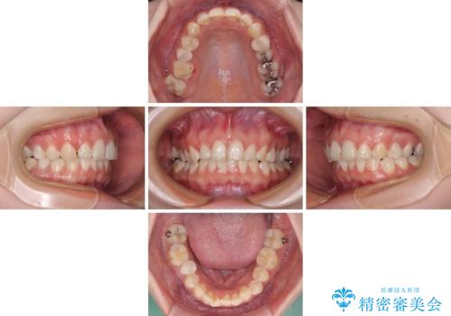 インビザライン単独では困難 補助装置を併用した矯正治療の治療中