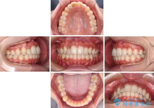 抜けてしまうと言われた前歯 インビザラインによる矯正治療の治療中