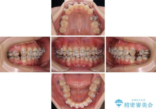 前歯の歯並びを治したい ワイヤー装置での抜歯矯正の治療中