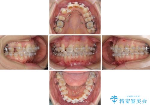 内側にある歯が邪魔 重なった前歯の歯列矯正の治療中