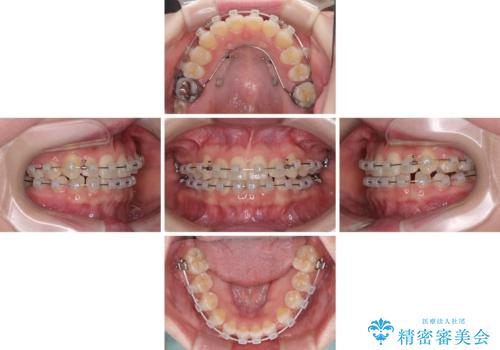 奥歯の欠損を放置 大臼歯を抜歯した矯正治療の治療中
