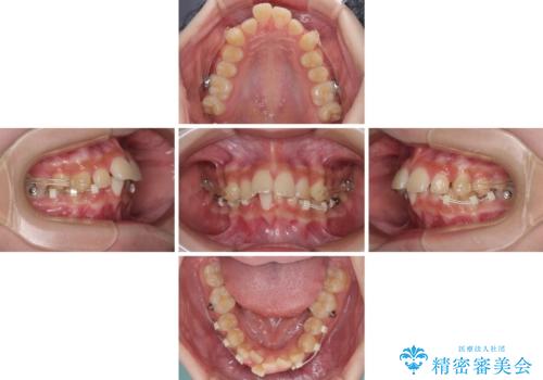 下の前歯が隠れてしまうほど深い咬み合わせ 高校生のインビザライン矯正治療の治療中