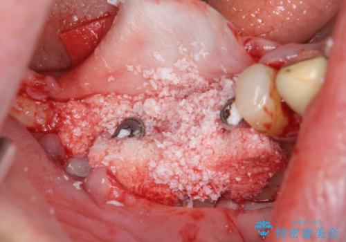 薄い骨幅 骨造成 歯肉移植を併用したインプラント治療の治療前