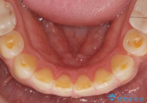 歯ぎしりですり減った 前歯の見た目を回復したいの治療前