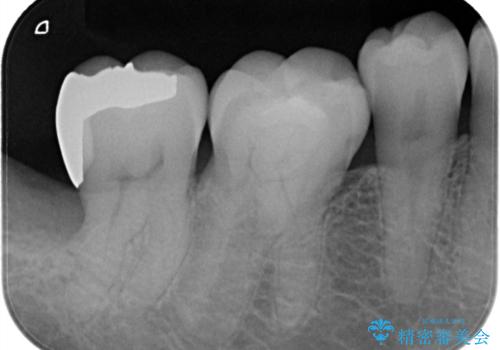 親知らずが原因の深いむし歯の治療後