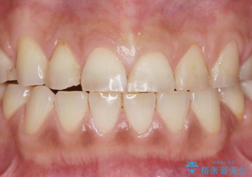歯ぎしりですり減った 前歯の見た目を回復したいの症例 治療前