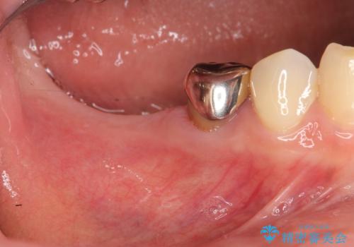 インプラント治療による咬合機能回復の症例 治療前