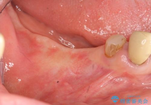 薄い骨幅 骨造成 歯肉移植を併用したインプラント治療の治療中