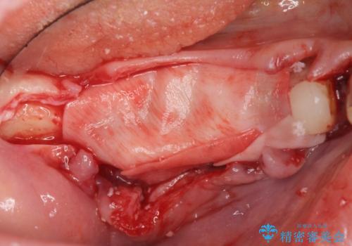 薄い骨幅 骨造成 歯肉移植を併用したインプラント治療の治療前