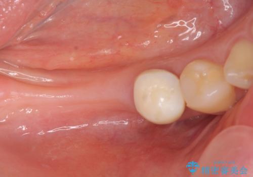 インプラント治療による咬合機能回復の治療中