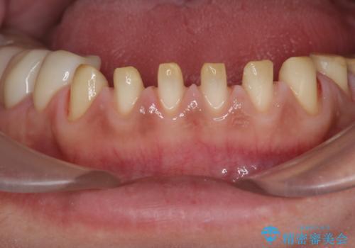 歯ぎしりですり減った 前歯の見た目を回復したいの治療中