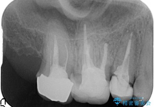 保険で治療した歯が欠けた。オールセラミッククラウンによる修復の治療前
