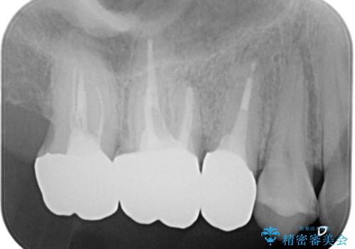 保険で治療した歯が欠けた。オールセラミッククラウンによる修復の治療後