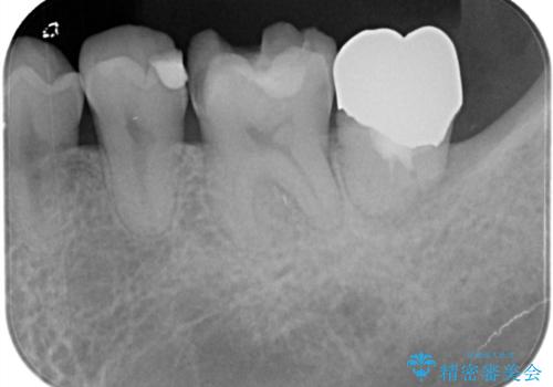 金属の詰め物がはずれた。の治療前
