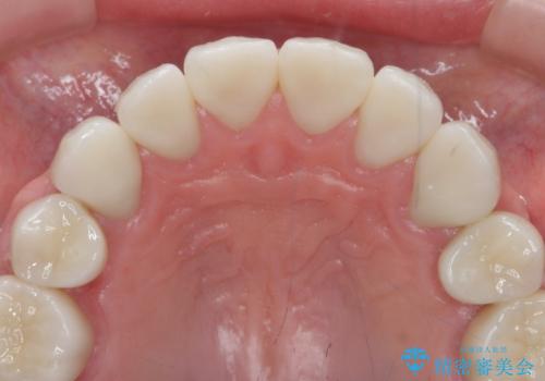 歯ぎしりですり減った 前歯の見た目を回復したいの治療後