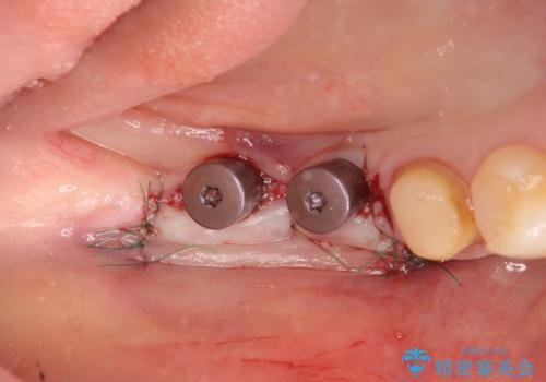 インプラント治療による咬合機能回復の治療中