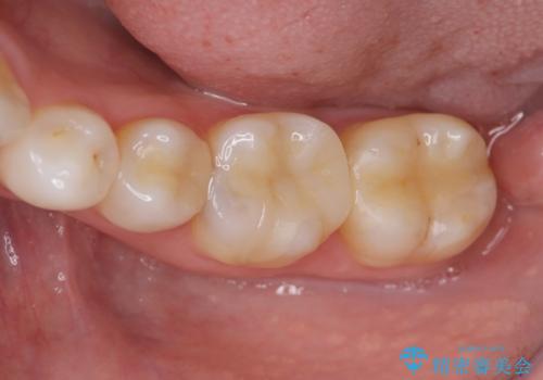 目立つ銀歯を自然にしたい