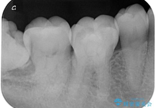 親知らずが原因の深いむし歯の治療前