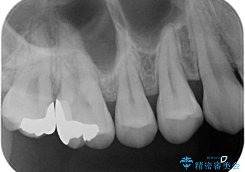 他院で入れたインレーの下にむし歯、ゴールドインレーで修復の治療後