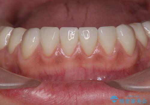 歯ぎしりですり減った 前歯の見た目を回復したいの治療後