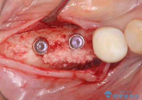インプラント治療による咬合機能回復の治療中