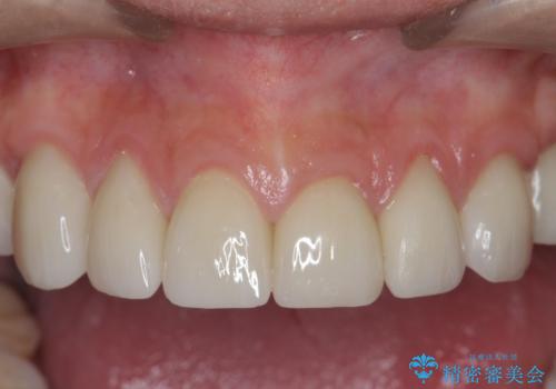 歯ぎしりですり減った 前歯の見た目を回復したいの治療後