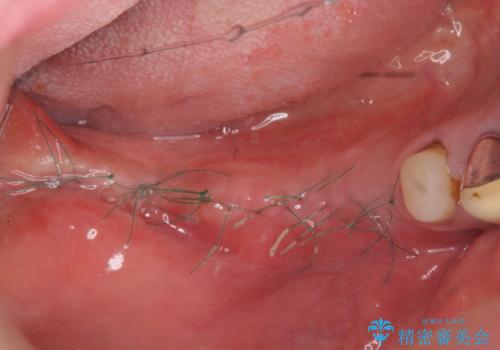 薄い骨幅 骨造成 歯肉移植を併用したインプラント治療の治療前
