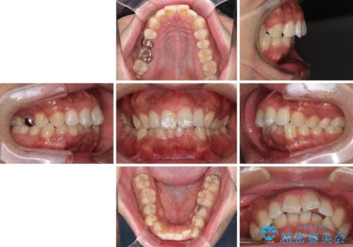 インビザラインによる矯正治療と、折れてしまった歯のインプラント補綴治療の治療前