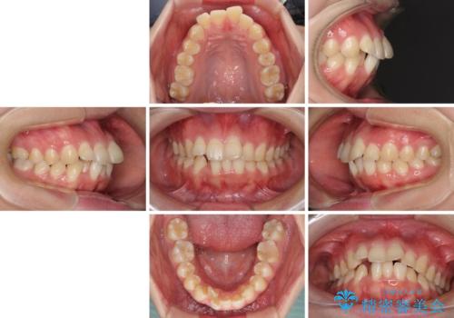 前歯の出っ歯と口の閉じにくさを抜歯矯正で改善 目立たないワイヤー矯正の治療前