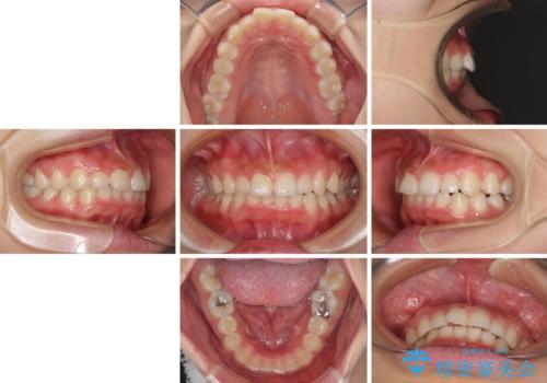 前歯のデコボコと突出感 インビザラインによる矯正治療の治療前