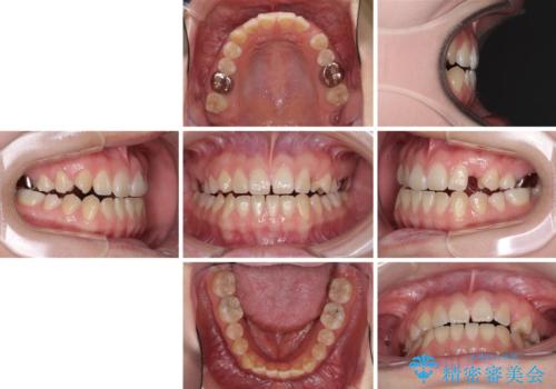 受け口で開咬を急速拡大装置とインビザラインで改善　欠損部分はインプラントにて補綴治療の治療前