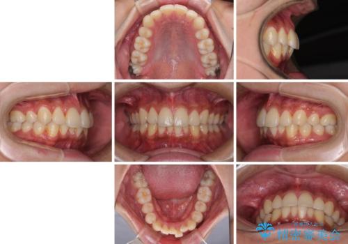 矯正治療の後戻りをインビザライン・ライトで解消の治療前