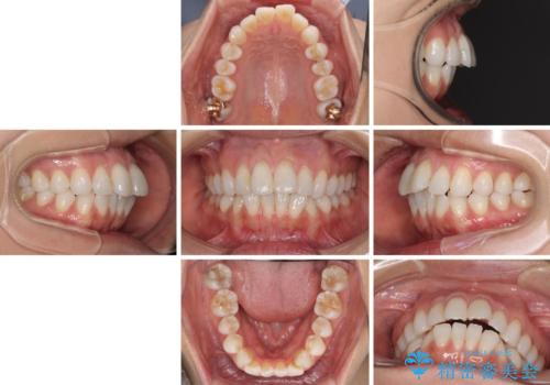 少しだけ飛び出た前歯を整えたい インビザラインによる矯正治療の治療前