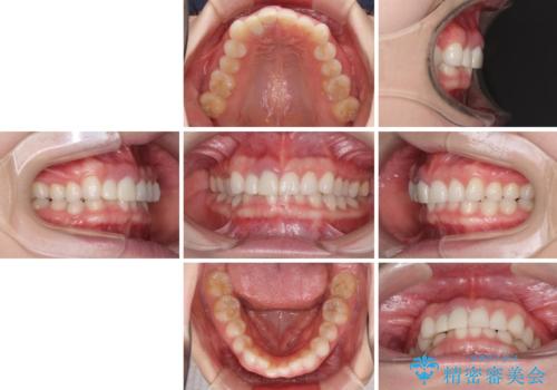 一度諦めた矯正にチャレンジしたい インビザラインとセラミック治療の治療前