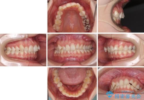 インビザライン単独では困難 補助装置を併用した矯正治療の治療前