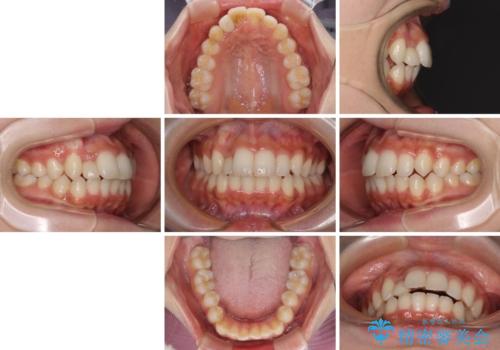 抜けてしまうと言われた前歯 インビザラインによる矯正治療の治療前
