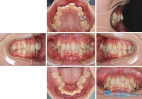 前歯の歯並びを治したい ワイヤー装置での抜歯矯正の治療前
