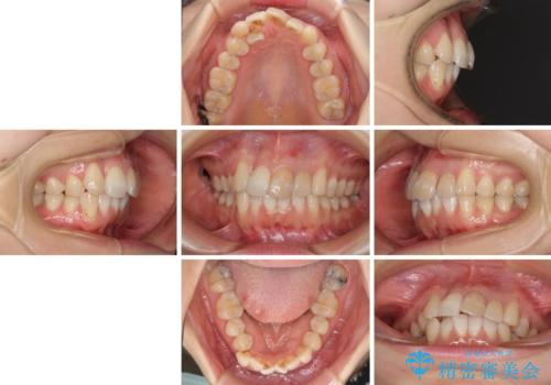内側にある歯が邪魔 重なった前歯の歯列矯正の治療前