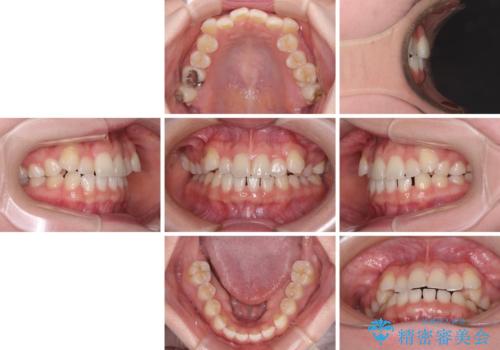 奥歯の欠損を放置　大臼歯を抜歯した矯正治療の治療前