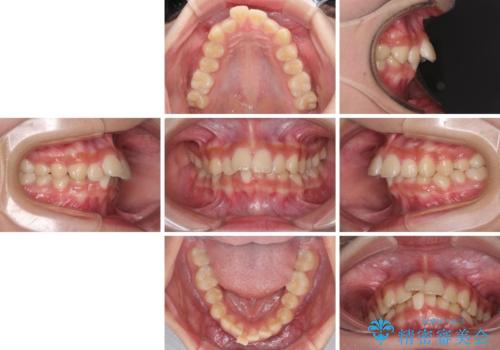 下の前歯が隠れてしまうほど深い咬み合わせ 高校生のインビザライン矯正治療の治療前