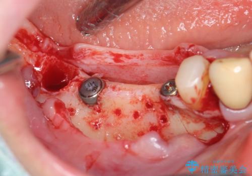 薄い骨幅 骨造成 歯肉移植を併用したインプラント治療の治療前