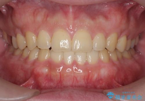 インビザラインで行うカモフラージュ矯正の症例 治療後