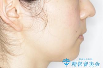 見た目だけじゃない:マウスピースでも短期間で噛み合わせと口元を改善の治療前(顔貌)