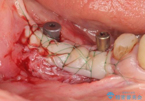 薄い骨幅　骨造成　歯肉移植を併用したインプラント治療の治療中