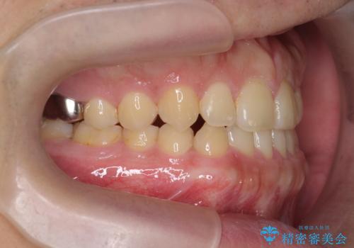 インビザラインで行うカモフラージュ矯正の治療後