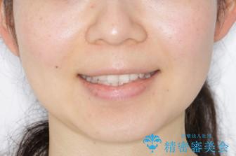 見た目だけじゃない:マウスピースでも短期間で噛み合わせと口元を改善の治療前(顔貌)