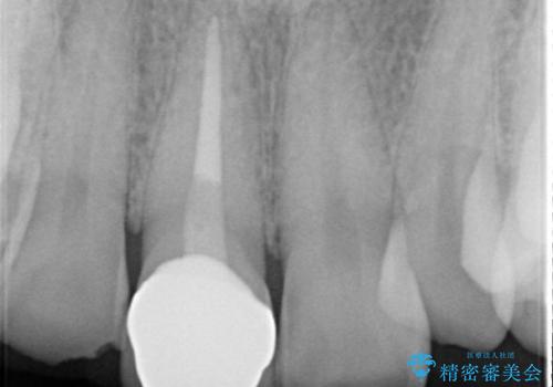 セラミックによる前歯の変色の改善の治療後