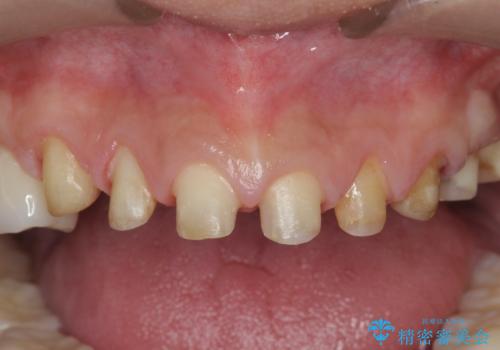 歯ぎしりですり減った 前歯の見た目を回復したいの治療中